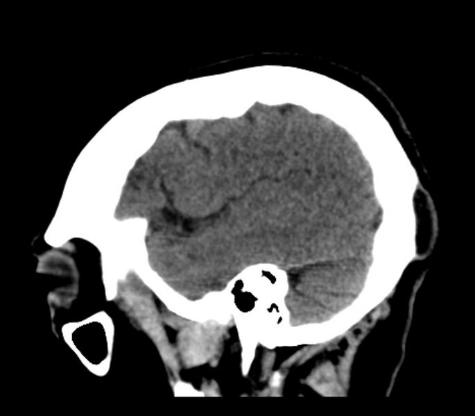 File:Chronic bilateral occipital lobe infarcts (Radiopaedia 31276-31996 C 32).jpg