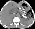 Chronic calcific pancreatitis (Radiopaedia 5532-7278 Axial non-contrast 1).jpg