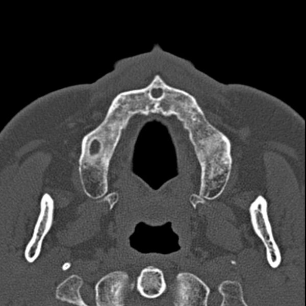 File:Chronic maxillary sinusitis (Radiopaedia 27879-28116 Axial bone window 3).jpg