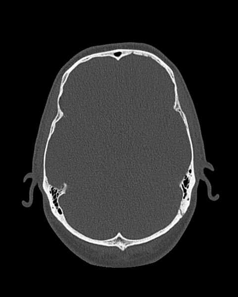 File:Chronic maxillary sinusitis caused by a foreign body (Radiopaedia 58521-65676 Axial bone window 307).jpg