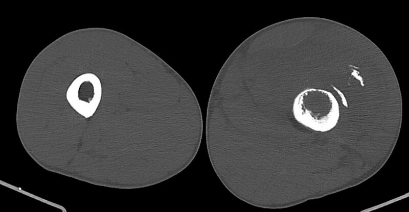 File:Chronic osteomyelitis (with sequestrum) (Radiopaedia 74813-85822 Axial non-contrast 92).jpg