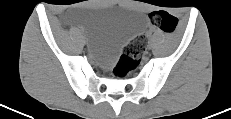 File:Chronic osteomyelitis (with sequestrum) (Radiopaedia 74813-85822 D 13).jpg