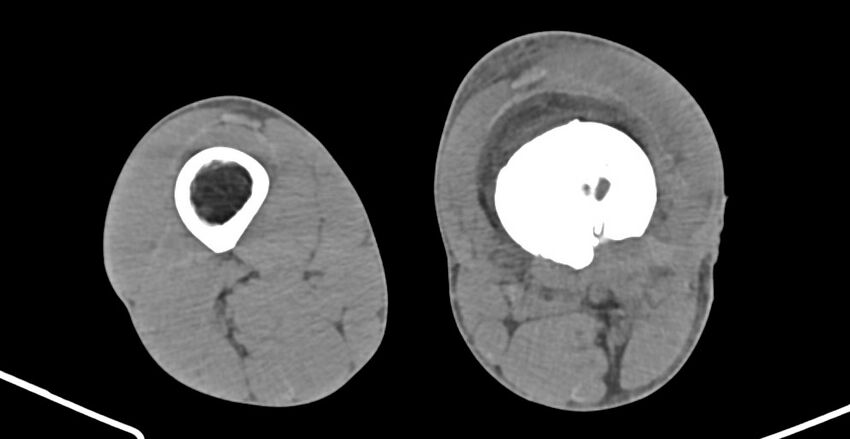 Chronic osteomyelitis (with sequestrum) (Radiopaedia 74813-85822 D 145).jpg