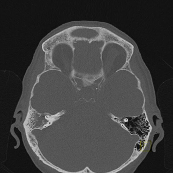 File:Chronic otitis media (Radiopaedia 14994-14912 Axial bone window 1).JPEG
