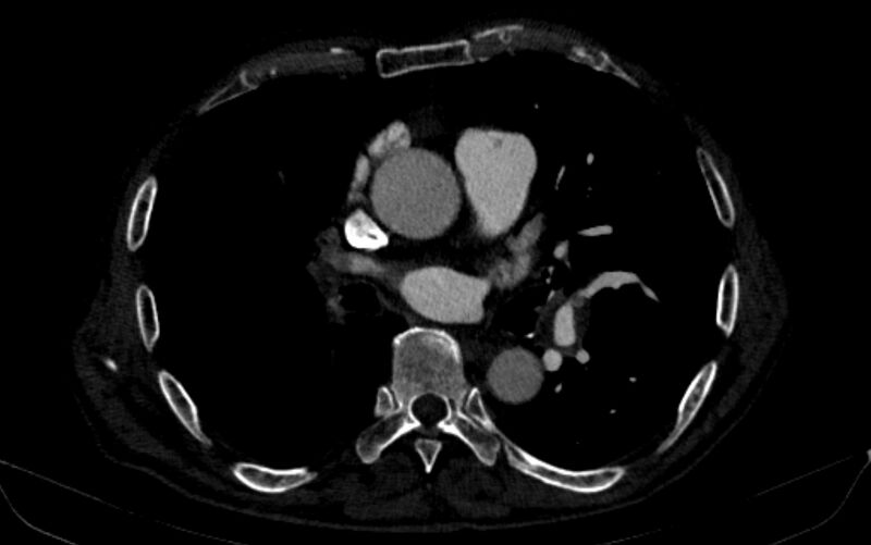 File:Chronic pulmonary embolism (Radiopaedia 91241-108843 B 98).jpg