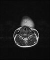 Chronic reactive multifocal osteomyelitis (CRMO) - mandible (Radiopaedia 56405-63069 Axial T2 2).jpg