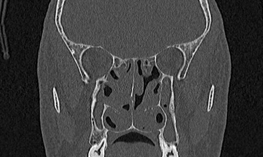 Chronic rhinosinusitis (Radiopaedia 65079-74075 Coronal bone window 48).jpg