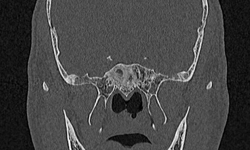File:Chronic rhinosinusitis (Radiopaedia 65079-74075 Coronal bone window 73).jpg