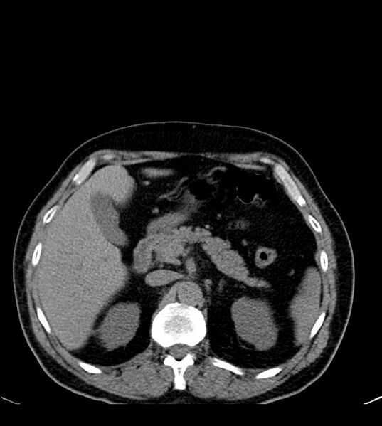 File:Clear cell renal cell carcinoma (Radiopaedia 85006-100539 Axial non-contrast 29).jpg