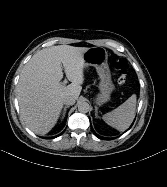 File:Clear cell renal cell carcinoma (Radiopaedia 85006-100539 H 1).jpg
