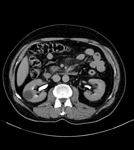 File:Clear cell renal cell carcinoma (Radiopaedia 85006-100539 H 17).jpg