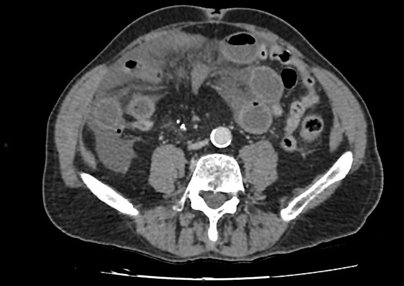 File:Closed loop small bowel obstruction with ischemia (Radiopaedia 84180-99456 A 71).jpg
