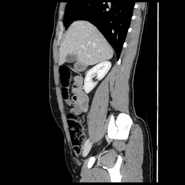 File:Co-existing acute appendicitis and epiploic appendagitis (Radiopaedia 61789-69911 B 30).jpg