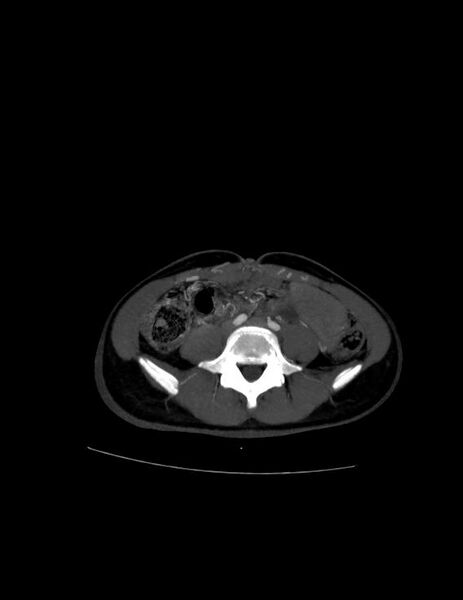 File:Coarctation of the aorta (Radiopaedia 27458-27657 D 38).jpg
