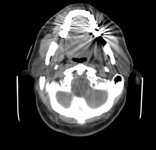 File:Colloid cyst of thyroid (Radiopaedia 22897-22923 Axial non-contrast 12).jpg
