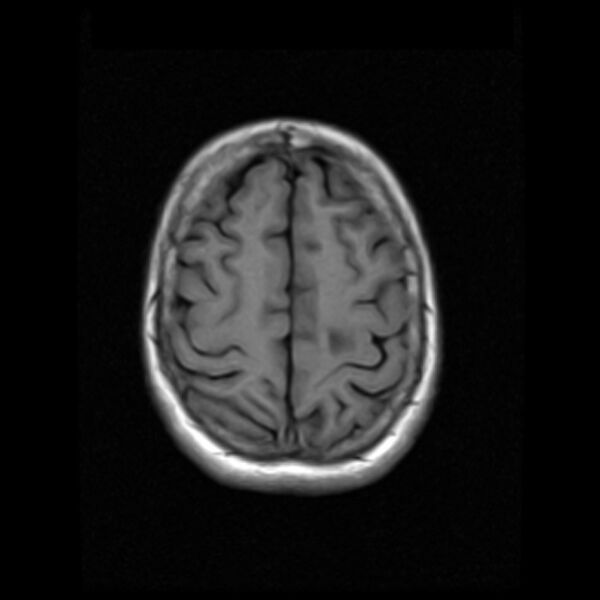 File:Colloid cyst with hydrocephalus (Radiopaedia 9373-10065 Axial T1 16).jpg