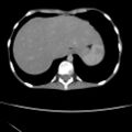 Colocolic fistula - Crohn disease (Radiopaedia 57063-63955 A 4).jpg
