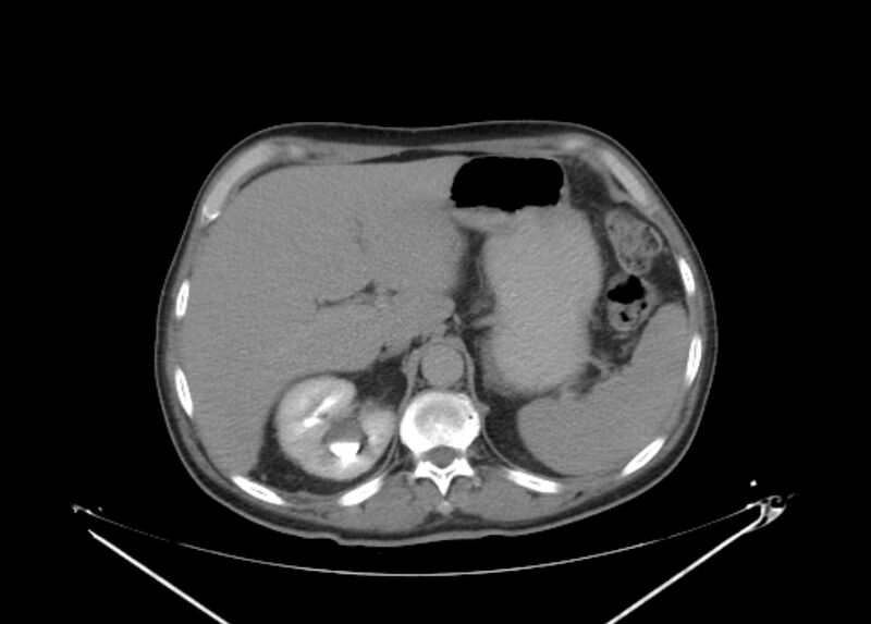 File:Colon cancer mimicking renal cell carcinoma (Radiopaedia 28986-29335 Axial C+ delayed 17).jpg