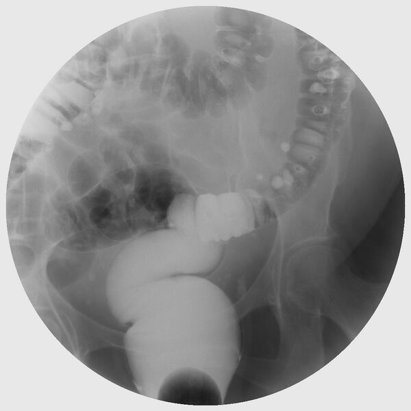 File:Colonic diverticulosis on single and double contrast barium enema (Radiopaedia 42254-45340 Double contrast 1).jpg