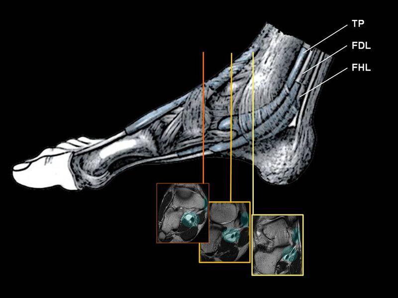 File:Extrinsic deep flexor tendons of the foot (Radiopaedia 16869).jpg