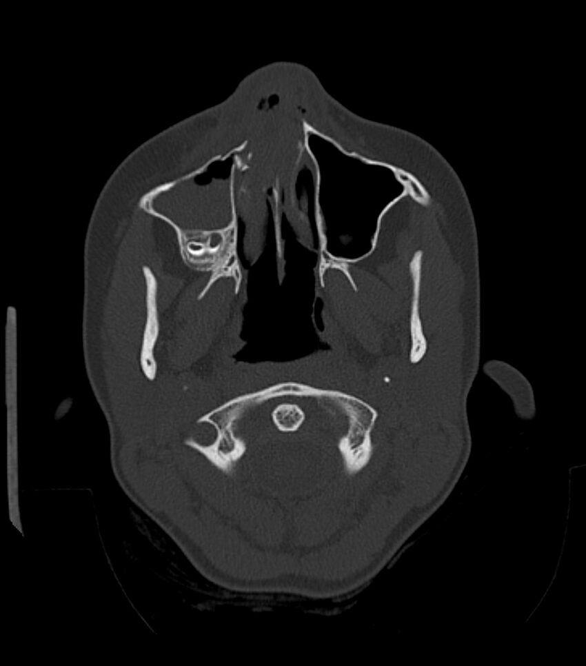Nasoorbitoethmoid fracture (Radiopaedia 90044-107205 Axial bone window 58).jpg