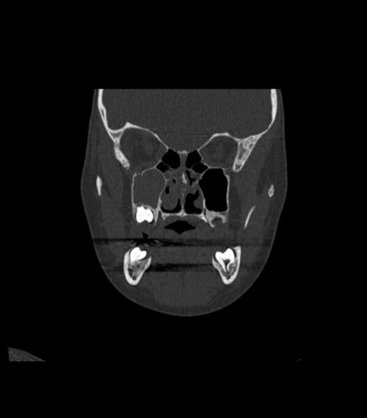 File:Nasoorbitoethmoid fracture (Radiopaedia 90044-107205 Coronal bone window 57).jpg
