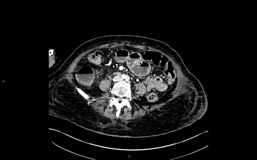Neo-terminal ileal stricture (Crohn disease) (Radiopaedia 33790-34948 A 267).jpg