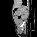 Neonatal neuroblastoma (Radiopaedia 56651-63438 C 32).jpg