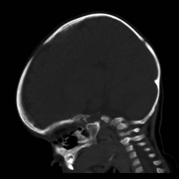 File:Neuroblastoma with skull metastases (Radiopaedia 30326-30958 Sagittal bone window 17).jpg