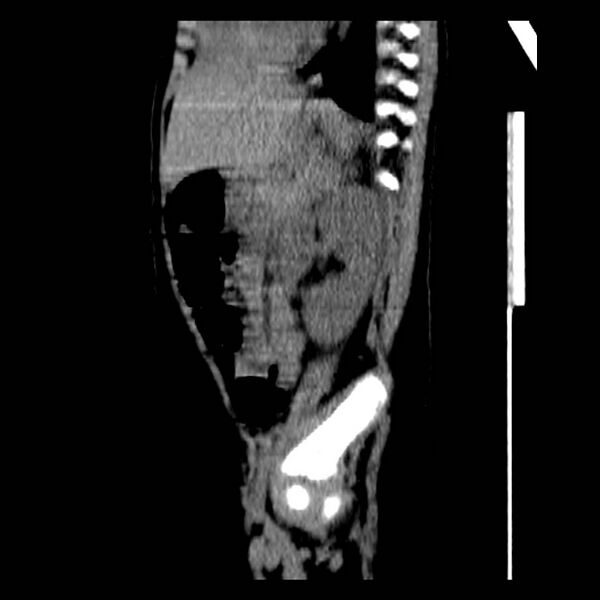 File:Neuroblastoma with skull metastases (Radiopaedia 30326-30960 B 29).jpg