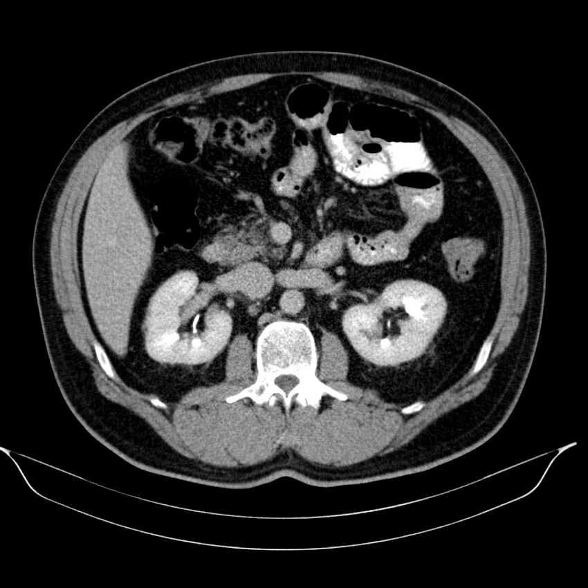 Neuroendocrine tumor of head of pancreas (Radiopaedia 57538-64502 D 35).jpg