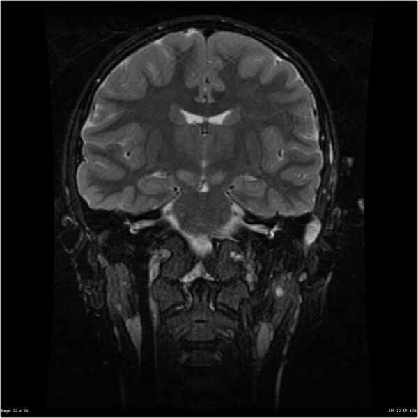 File:Neurofibromatosis type 1 (Radiopaedia 22541-22564 Coronal T2 fat sat 13).jpg