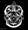 Neurosarcoidosis (Radiopaedia 10930-11351 Axial FLAIR 1).jpg