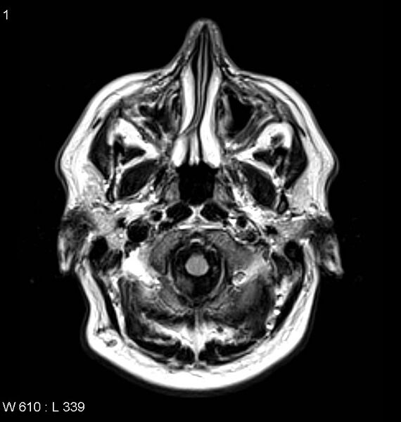 File:Neurosarcoidosis (Radiopaedia 10930-11351 Axial FLAIR 1).jpg
