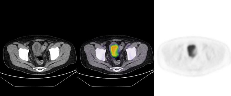 File:Non-Hodgkin lymphoma involving seminal vesicles with development of interstitial pneumonitis during Rituximab therapy (Radiopaedia 32703-33752 ax CT Fus PET 58).jpg