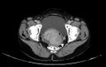 Non-puerperal uterine inversion (Radiopaedia 78343-91094 A 60).jpg