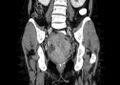 Non-puerperal uterine inversion (Radiopaedia 78343-91094 B 30).jpg