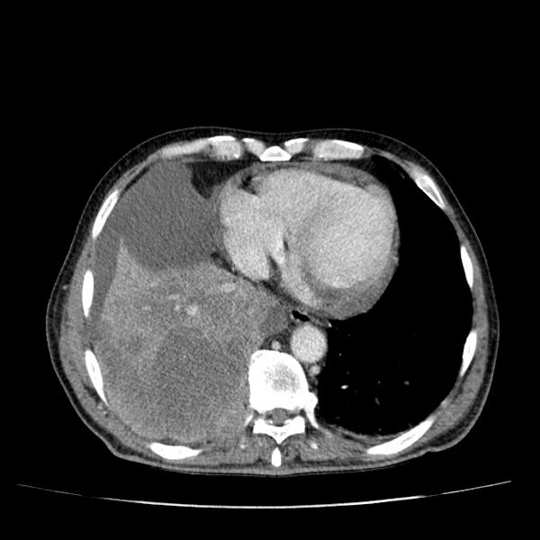 File:Non small-cell lung cancer (Radiopaedia 24467-24769 C+ delayed 45).jpg