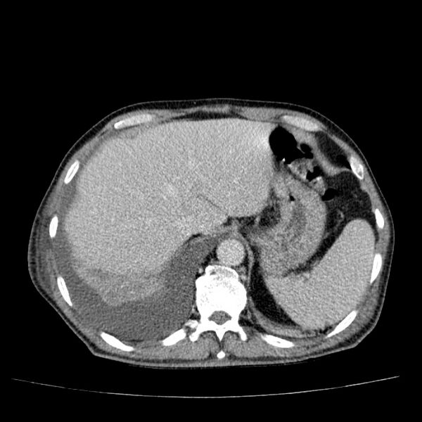 File:Non small-cell lung cancer (Radiopaedia 24467-24769 C+ delayed 55).jpg