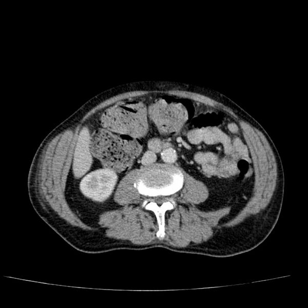 File:Non small-cell lung cancer (Radiopaedia 24467-24769 C+ delayed 81).jpg