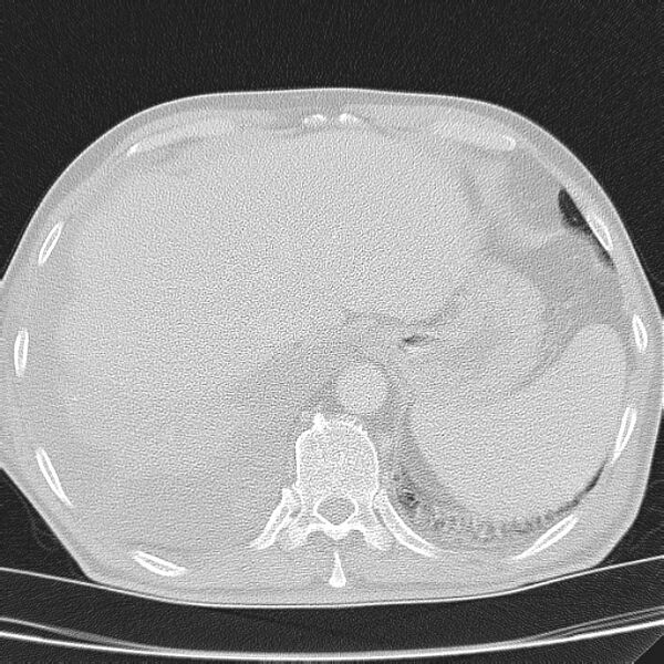 File:Non small-cell lung cancer (Radiopaedia 24467-24769 lung window 47).jpg