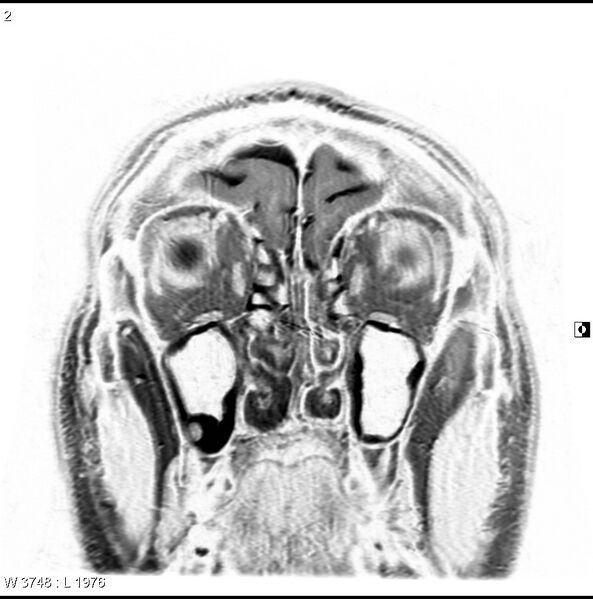 File:Normal coronal brain (Radiopaedia 6676-7910 B 2).jpg