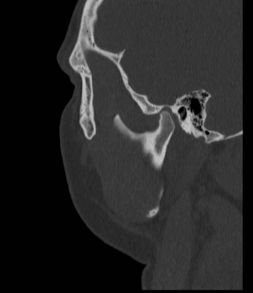 Normal facial bone CT (Radiopaedia 88742-105476 Sagittal bone window 136).jpg