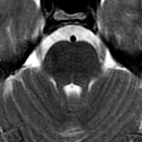 File:Normal fourth ventricle (Radiopaedia 36246).jpg