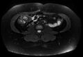 Normal liver MRI with Gadolinium (Radiopaedia 58913-66163 Axial T2 fat sat 5).jpg