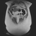 Normal liver MRI with Gadolinium (Radiopaedia 58913-66163 Coronal T2 9).jpg