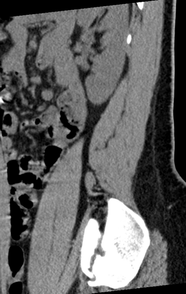 File:Normal lumbar spine CT (Radiopaedia 46533-50986 C 13).png