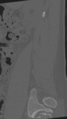Normal lumbar spine CT (Radiopaedia 46533-50986 Sagittal bone window 84).png