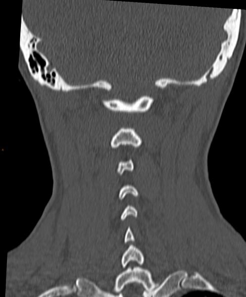 File:Occipital condyle fracture (Radiopaedia 61165-69056 Coronal bone window 3).jpg