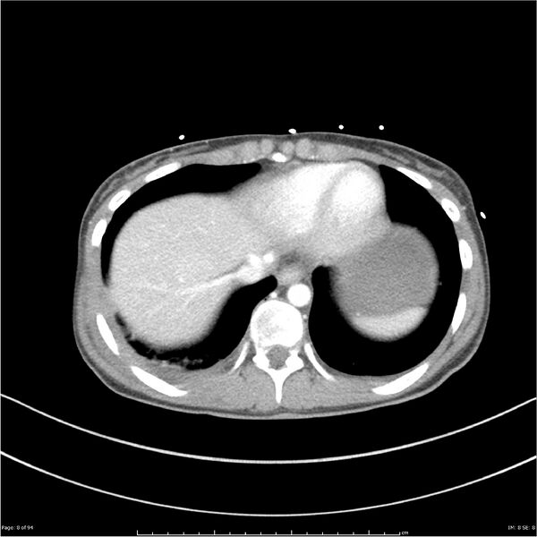 File:Traumatic renal artery dissection and pancreatic transection (Radiopaedia 37061-38739 Axial 287).jpg
